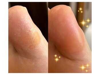 アベビー(Abeby)/親指のタコ