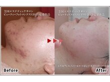パール(Pearl)の雰囲気（悩んでいる赤身も水光肌ピーリングで払拭！まずはお試し価格で♪）