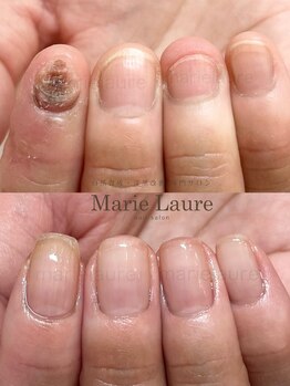 マリーロール 梅田店(Marie Laure)/深爪矯正/自爪育成/自爪風