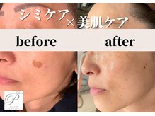 パールホワイトニングサロン 小田原店/シミケアと毛穴ケアが同時に叶う