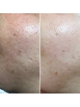 サロンハッピー(salon HAPPY)/カーボンピーリング効果