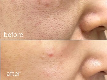 ソレイユ(Soleil)/毛穴・角質ケア