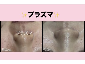 エステティック　レイビス 渋谷店(RAYVIS)/脱毛×フェイシャル