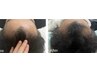 【分け目・トップのボリュームが気になる方へ】EXOふんわり育毛促進ケア