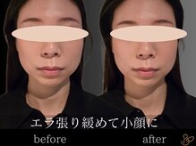 チョコバリ 恵比寿店(chocobari)/小顔リフトアップ（美容鍼）30代