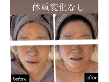 ルキア(LUKIA)の写真/【効果実感率98%超え◎】二重あごタルミ改善に特化した専門家が施術☆お顔の脂肪・たるみに徹底アプローチ!