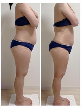 エヌラボ(N.LABO)/痩身