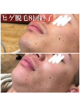 ヘアーズヨシオカ(HAIR'S YOSHIOKA)/#ヒゲ脱毛ビフォーアフター