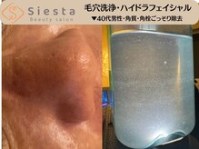 シエスタ(siesta)/男性にも人気の毛穴洗浄