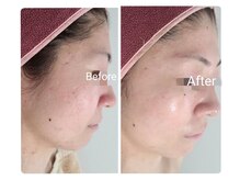 サロン ド ハニー(Salon de Honey)/ハーブピーリング