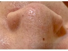 毛穴の奥から汚れを浮き上がらせて、すっきり空っぽ毛穴へ