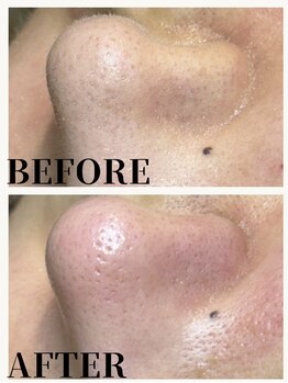 エミルカ 自由が丘店(EMILUCA)/毛穴エクストラクション