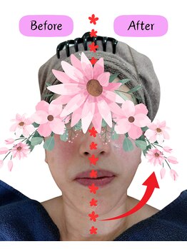 エバンス ノット(Evans knot)/リフティングビフォーアフター