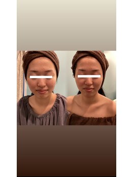 アンジェリック ビーナス(Angelic Venus)/超小顔コース♪