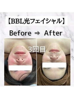 リラッシュ 岡山駅前店(Re:lash)/BBL光フェイシャル♪