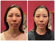 クランシュプール恵比寿鍼灸院/ビフォーアフター/5回の変化！