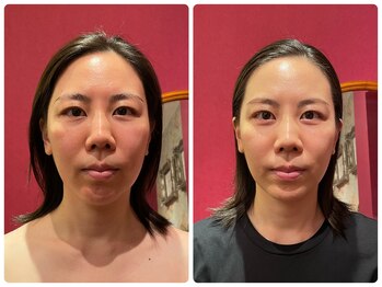 クランシュプール恵比寿鍼灸院/ビフォーアフター/5回の変化!