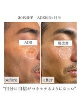 リセ(RESE)/男性肌改善ADS約3ヶ月