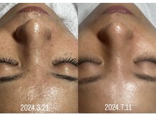 スパークル/くすみ/毛穴/ヘッドスパ/毛穴