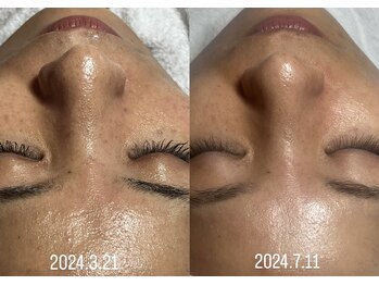 スパークル/くすみ/毛穴/ヘッドスパ/毛穴