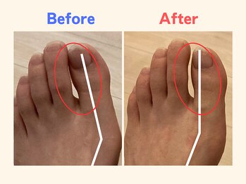 ピース/親指の曲がりにお悩みの30代女性