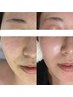 人気☆毛穴汚れを徹底除去【肌質改善】毛穴洗浄+IPL光フェイシャル