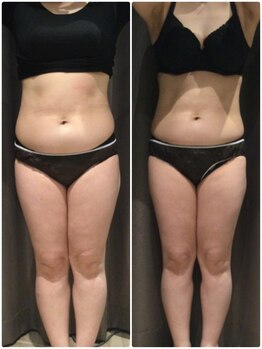 アイスタイル(i-style)/脂肪冷却/痩身ダイエット/泉大津