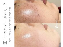 ミミルーチェ(mimiluce)/オトナ肌革命ハーブピーリング◎