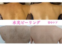 ミレット(Miretto)/背中のシミに◎水光ピーリング