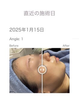 ハーブピーリング&フェイシャルサロン シーベル 福岡天神/こだわり/ハーブピーリング