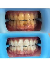 ホワイトニングセンター 富山二口店/富山　二口町ホワイトニング