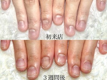 グラシナ 鳥丸店の写真/爪が弱い、深爪、噛み癖にお悩みの方へ。京都烏丸で丁寧なハンドケアと美爪矯正◎