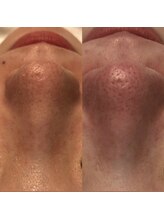 ナラビューティー(NARA BEAUTY)/ハイドラフェイシャル写真