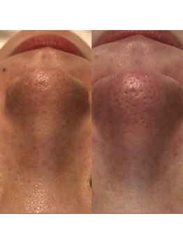 ナラビューティー(NARA BEAUTY)/ハイドラフェイシャル写真