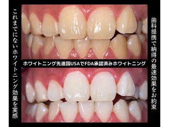 ユーラボ 表参道(YOU-LAB)/Befor/After【ホワイトニング】