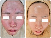 クレイルサロン(Claire salon)/(左)初回(右)３回目施術後