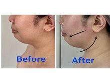 ラネージュ(LA NEIGE)/【札幌LA NEIGE】小顔/リフトUP