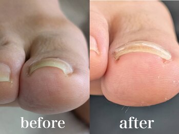 ドクターネイル爪革命 札幌本店/症例紹介9 巻き爪