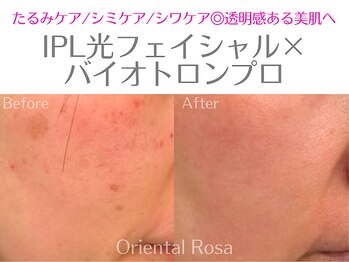 オリエンタルローザ 表参道(Oriental Rosa)/IPL光ケア◎様々な肌トラブルに