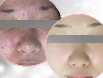 ナイア(naia)の写真/【黒ずみ毛穴が気になる方へ】吸引器具で汚れをすっきり除去！電気の力で毛穴を引き締め、黒ずみを予防♪