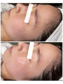 ダチュラ(Da'Chura)/水光肌になりたい!ララピール★