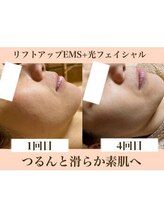 ラーナ(Lana)/リフトアップEMS×光