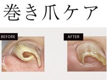 もう悩まない！特殊ジェルで巻爪ケア◎