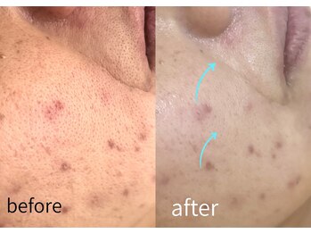 ルーム701(room701)/毛穴 たるみ ほうれい線