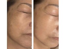 アドビューティ(Add Beauty)/≪プラズマフェイシャル≫