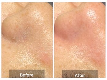 ステッラ(STELLA☆)/毛穴洗浄　Before/After