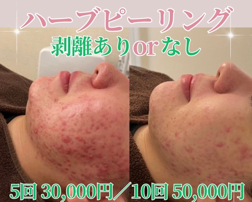 【オープン記念】剥離ありハーブピーリング10回分 剥離なし ハーブピーリング8回分｜Yahoo!フリマ（旧PayPayフリマ）