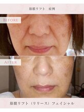 カピリナスパ(Ka.Pilina Spa) 筋膜リフト ★引き上げ