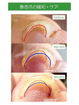 巻き爪改善