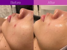 クレヴィア バイ サイバーエステ(CREBIA)/毛穴/ニキビ【アンストレス】